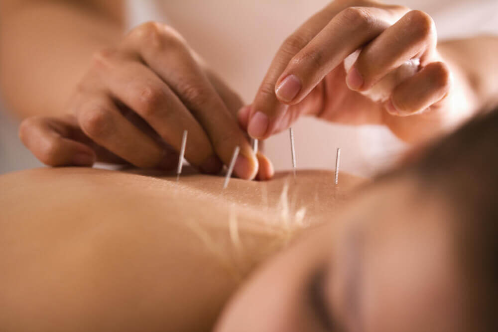 Natural and Alternative Therapy; Woman Having Acupuncture Treatment